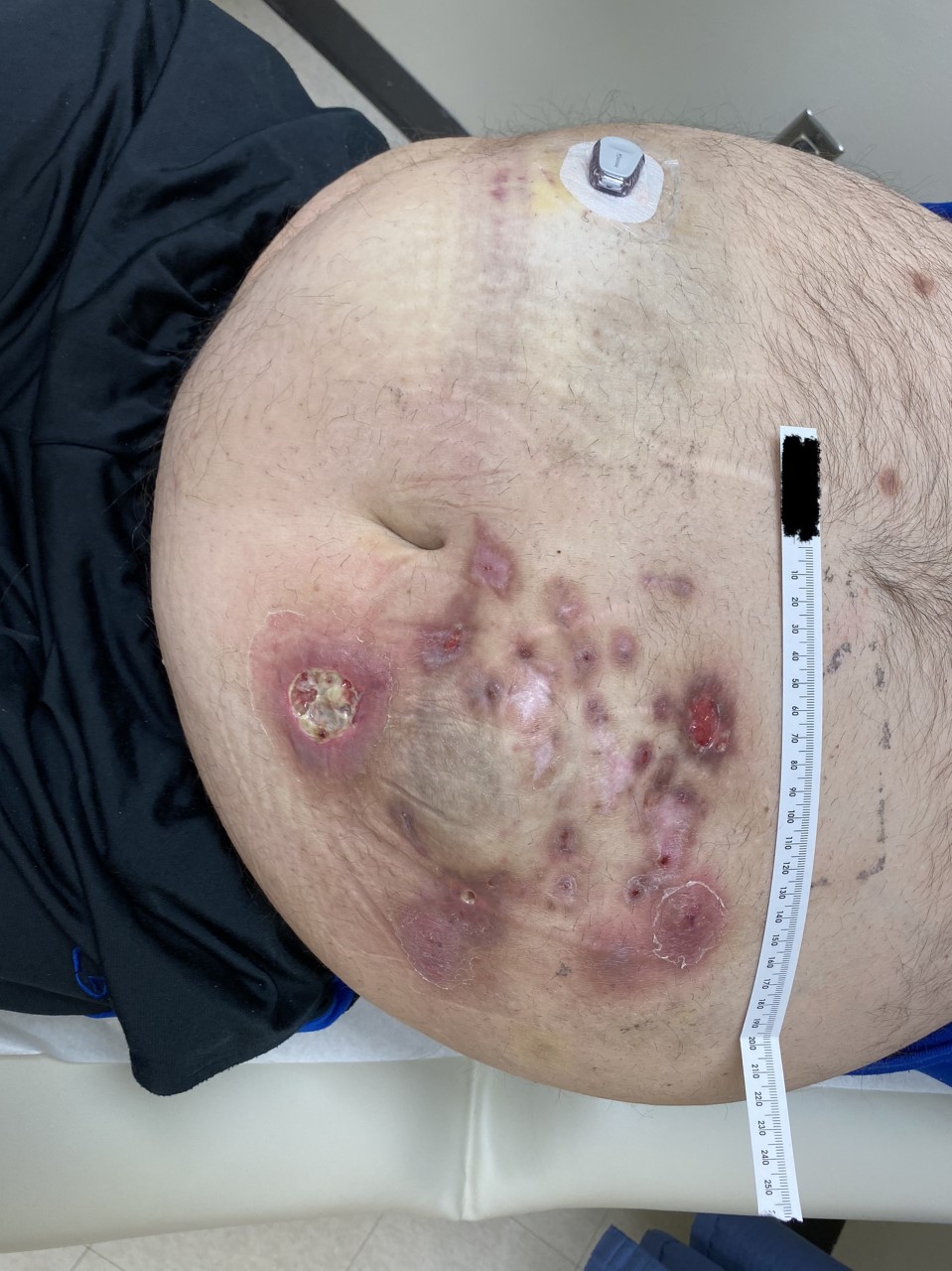 Cutaneous NTM infection – Infectious Disease Atlas